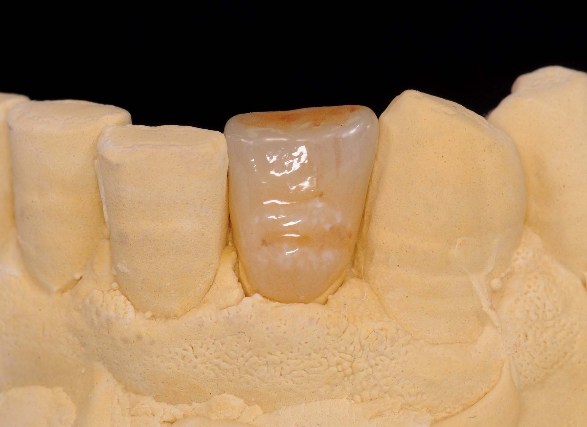 Veneer 32